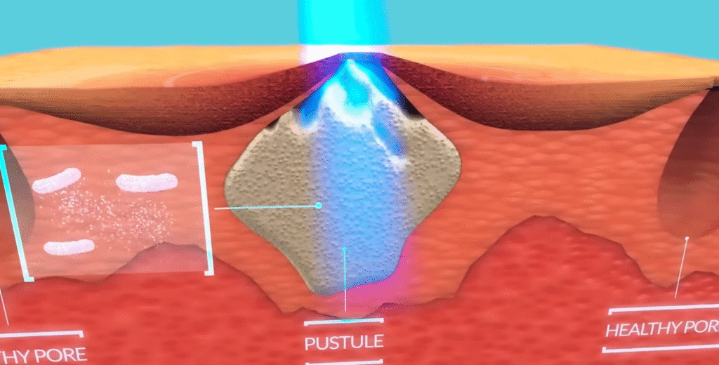 Science Behind LED blue Light Therapy for acne