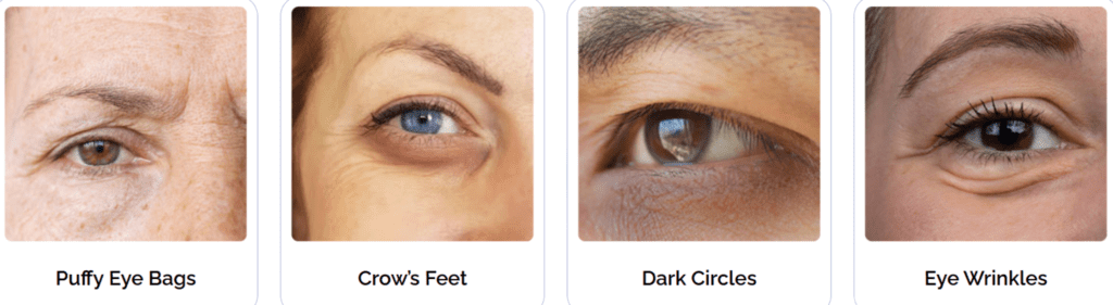 Renewa EyeLift Benefits for the Under-Eye Area